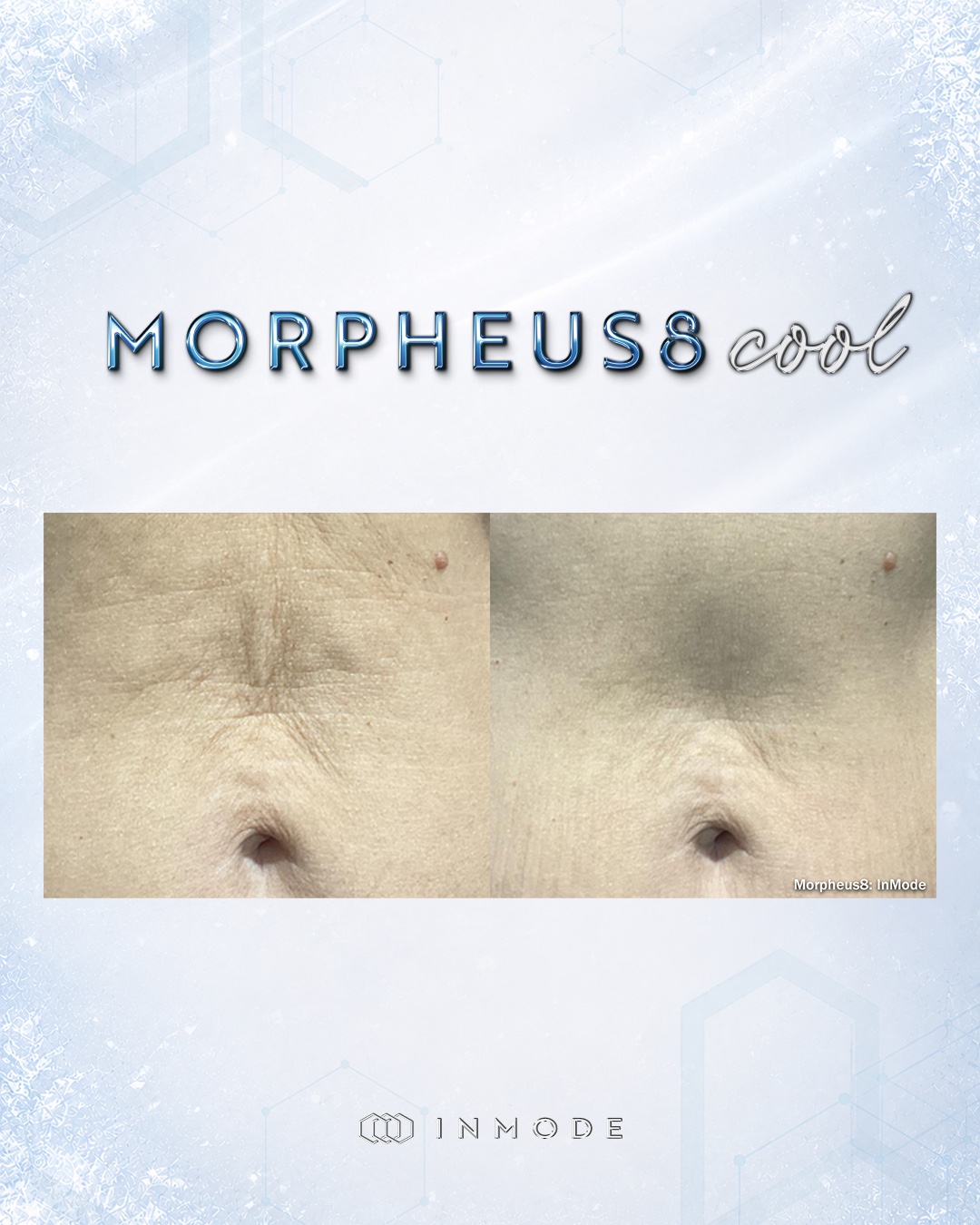 Official Morpheus8 before-and-after comparison showing abdominal skin texture