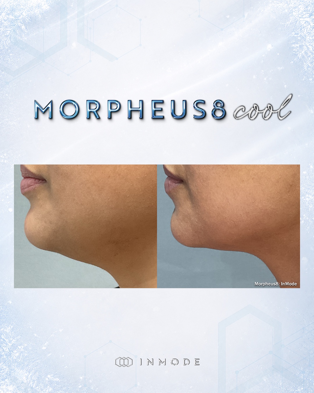 Official Morpheus8 before-and-after comparison showing the chin and jawline in profile