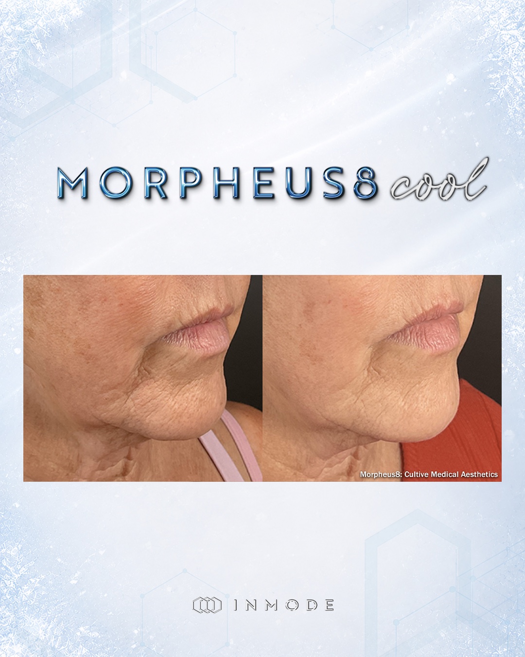 Official Morpheus8 before-and-after comparison showing lower-face texture