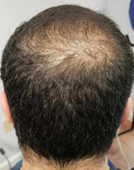 Alma TED hair treatment result