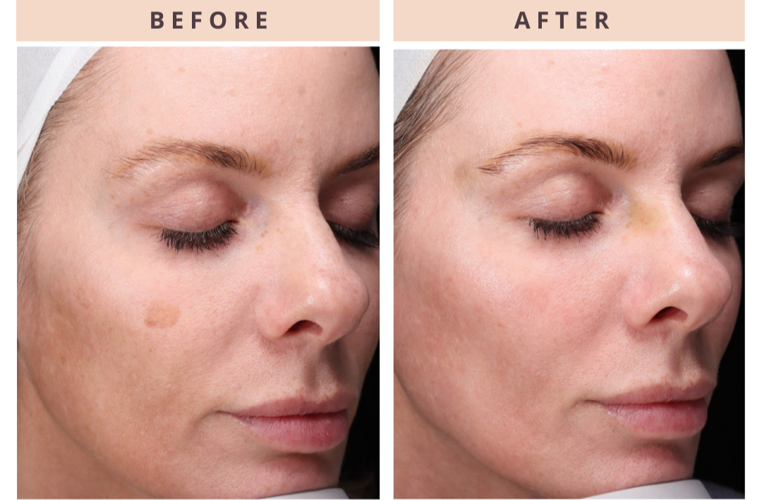 CoolPeel before and after result