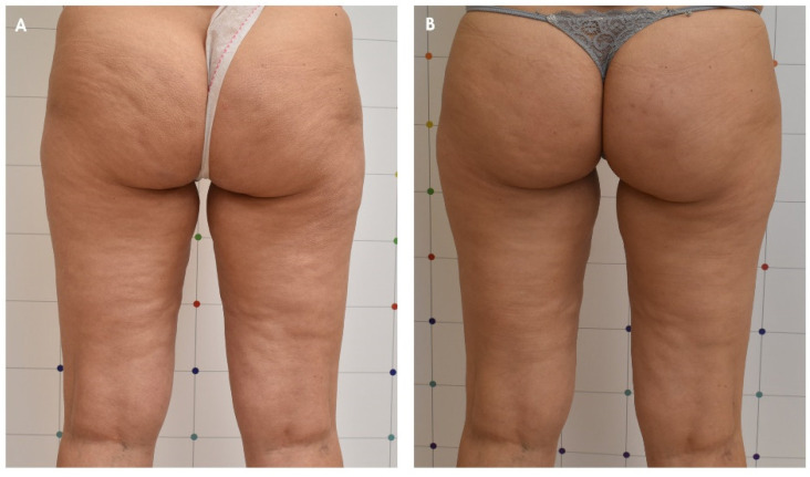 Before and three-month follow-up after ONDA cellulite treatment, posterior view