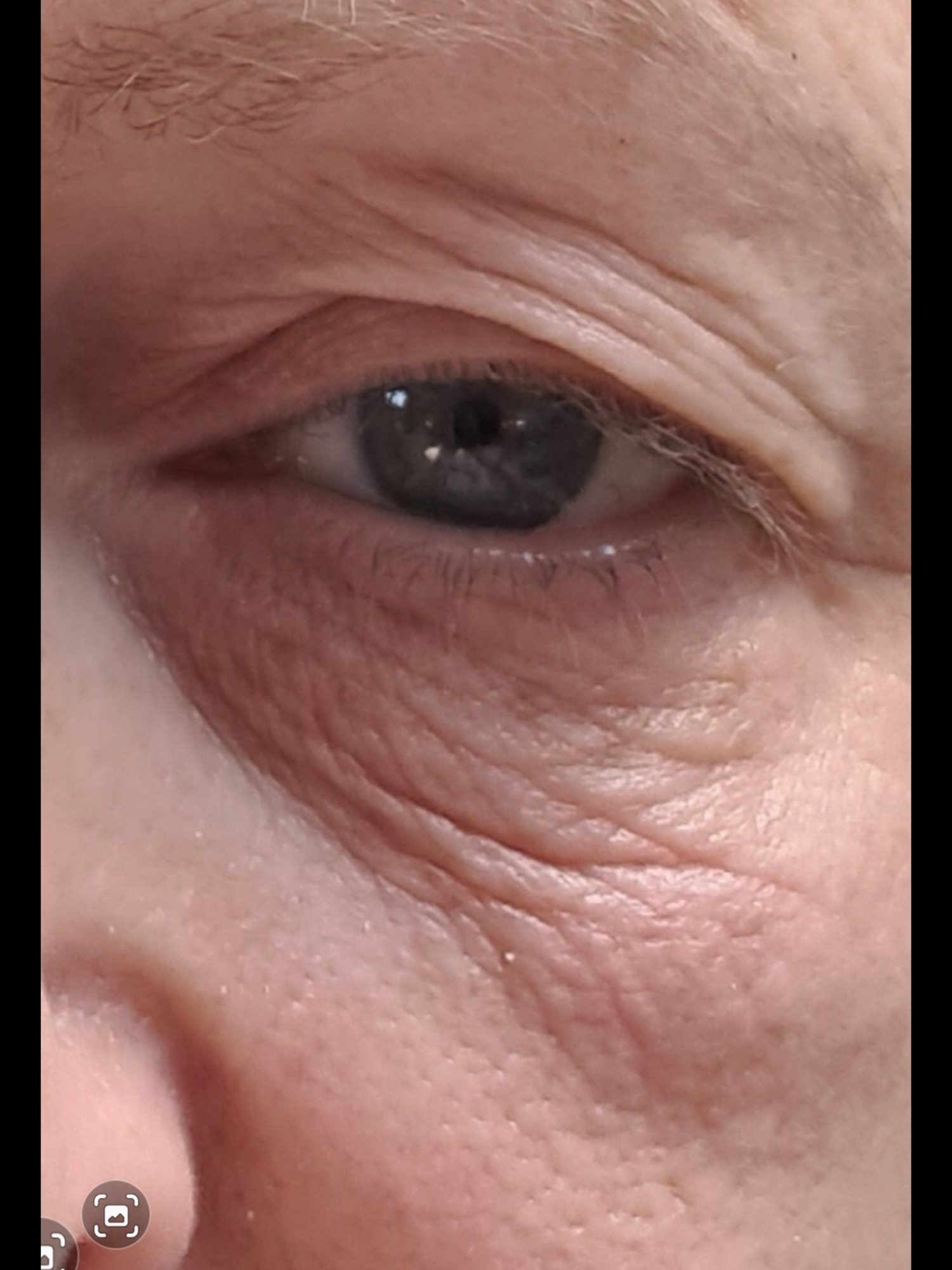 Before Sofwave eye treatment
