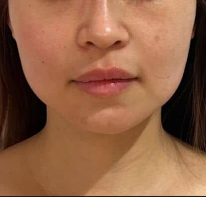 After TitaniumLift clinical example 1