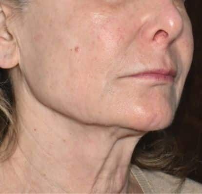 After TitaniumLift clinical example 2
