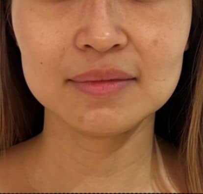 Before TitaniumLift clinical example 1
