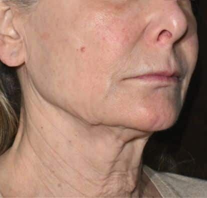 Before TitaniumLift clinical example 2