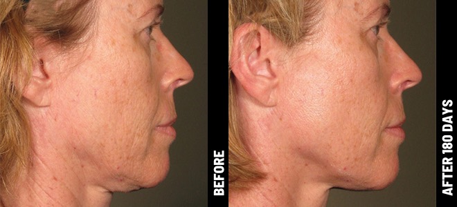 Ultherapy patient result